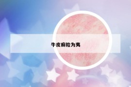 牛皮癬險(xiǎn)為夷