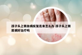 孩子頭上銀血病反復(fù)出來怎么辦 孩子頭上銀屑病好治療嗎