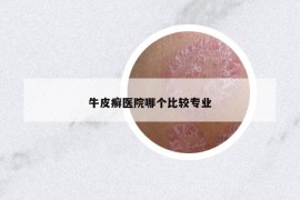 牛皮癬醫(yī)院哪個比較專業(yè)
