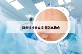 蘚怎樣才能去掉 蘚怎么治愈