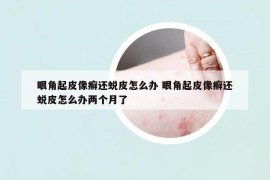眼角起皮像癬還蛻皮怎么辦 眼角起皮像癬還蛻皮怎么辦兩個月了
