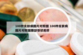 100種皮膚病圖片對(duì)照?qǐng)D 100種皮膚病圖片對(duì)照?qǐng)D腰部帶狀皰疹