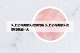 頭上總有類(lèi)似頭皮似的癬 頭上總有類(lèi)似頭皮似的癬是什么