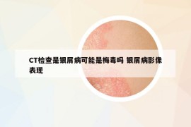 CT檢查是銀屑病可能是梅毒嗎 銀屑病影像表現(xiàn)