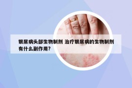 銀屑病頭部生物制劑 治療銀屑病的生物制劑有什么副作用?