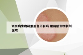 銀屑病生物制劑邢臺市有嗎 銀屑病生物制劑醫(yī)院
