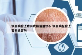 銀屑病臉上也有皮損消退快不 銀屑病在臉上容易毀容嗎