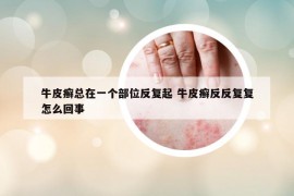 牛皮癬總在一個部位反復(fù)起 牛皮癬反反復(fù)復(fù)怎么回事