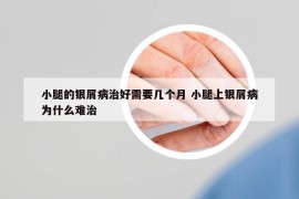 小腿的銀屑病治好需要幾個(gè)月 小腿上銀屑病為什么難治