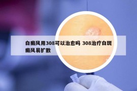 白癜風(fēng)用308可以治愈嗎 308治療白斑癜風(fēng)易擴(kuò)散