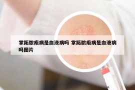 掌跖膿皰病是血液病嗎 掌跖膿皰病是血液病嗎圖片