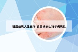 銀屑病男人生孩子 銀屑病能生孩子嗎男性