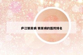 廬江銀屑病 銀屑病的醫(yī)院排名