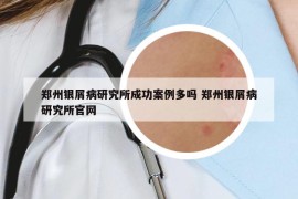 鄭州銀屑病研究所成功案例多嗎 鄭州銀屑病研究所官網(wǎng)
