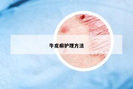 牛皮癬護理方法