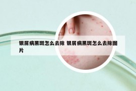 銀屑病黑斑怎么去除 銀屑病黑斑怎么去除圖片