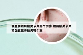 強(qiáng)直和銀屑病關(guān)節(jié)炎那個厲害 銀屑病關(guān)節(jié)炎和強(qiáng)直性脊柱炎哪個重