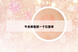牛皮癬是就一個位置癢