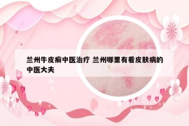 蘭州牛皮癬中醫(yī)治療 蘭州哪里有看皮膚病的中醫(yī)大夫