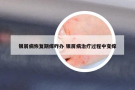 銀屑病恢復(fù)期癢咋辦 銀屑病治療過程中變癢