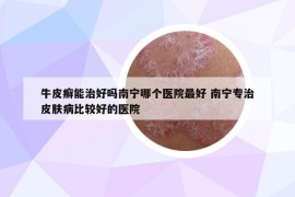 牛皮癬能治好嗎南寧哪個醫(yī)院最好 南寧專治皮膚病比較好的醫(yī)院