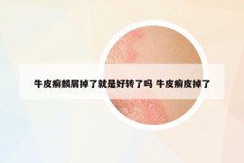 牛皮癬麟屑掉了就是好轉(zhuǎn)了嗎 牛皮癬皮掉了
