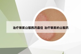 治療銀屑口服西藥最佳 治療銀屑的口服藥