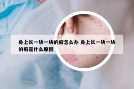 身上長一塊一塊的癬怎么辦 身上長一塊一塊的癬是什么原因