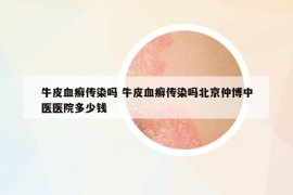 牛皮血癬傳染嗎 牛皮血癬傳染嗎北京仲博中醫(yī)醫(yī)院多少錢