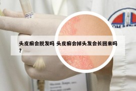 頭皮癬會(huì)脫發(fā)嗎 頭皮癬會(huì)掉頭發(fā)會(huì)長(zhǎng)回來(lái)嗎?