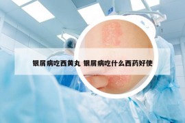 銀屑病吃西黃丸 銀屑病吃什么西藥好使