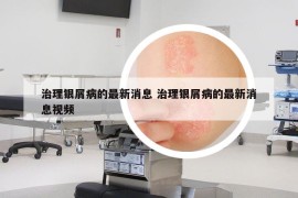 治理銀屑病的最新消息 治理銀屑病的最新消息視頻