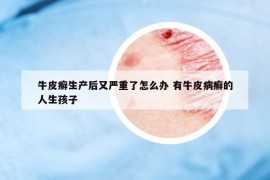 牛皮癬生產(chǎn)后又嚴(yán)重了怎么辦 有牛皮病癬的人生孩子