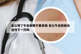 老公得了牛皮癬要不要離婚 老公牛皮膚癬會遺傳下一代嗎