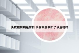 頭皮銀屑病經(jīng)?？?頭皮銀屑病扣了以后啥樣