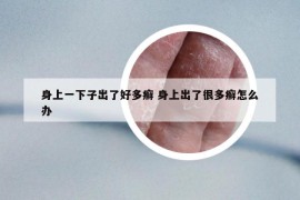 身上一下子出了好多癬 身上出了很多癬怎么辦