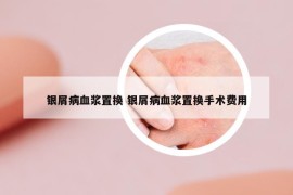銀屑病血漿置換 銀屑病血漿置換手術費用