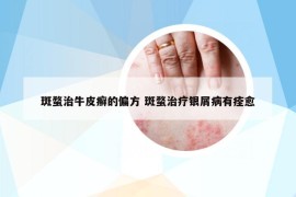 斑蝥治牛皮癬的偏方 斑蝥治療銀屑病有痊愈