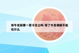 有牛皮蘚要一輩子忌口嗎 得了牛皮病癬不能吃什么