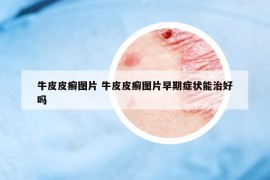 牛皮皮癬圖片 牛皮皮癬圖片早期癥狀能治好嗎