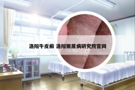 洛陽牛皮癬 洛陽銀屑病研究院官網