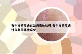 有牛皮癬能通過(guò)公務(wù)員體檢嗎 有牛皮癬能通過(guò)公務(wù)員體檢嗎女