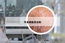 牛皮癬肌肉注射