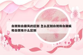 白斑和白巔風(fēng)的區(qū)別 怎么區(qū)別白斑和白顛瘋和白斑有什么區(qū)別
