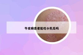 牛皮癬患者能吃小乳瓜嗎