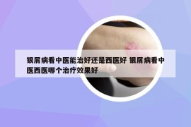 銀屑病看中醫(yī)能治好還是西醫(yī)好 銀屑病看中醫(yī)西醫(yī)哪個治療效果好