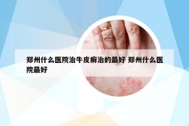 鄭州什么醫(yī)院治牛皮癬治的最好 鄭州什么醫(yī)院最好