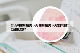 什么叫銀屑病關(guān)節(jié)炎 銀屑病關(guān)節(jié)炎怎樣治療效果比較好