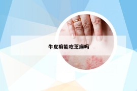 牛皮癬能吃芝麻嗎