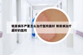 銀屑病不嚴(yán)重怎么治療醫(yī)院最好 銀屑病治療最好的醫(yī)院